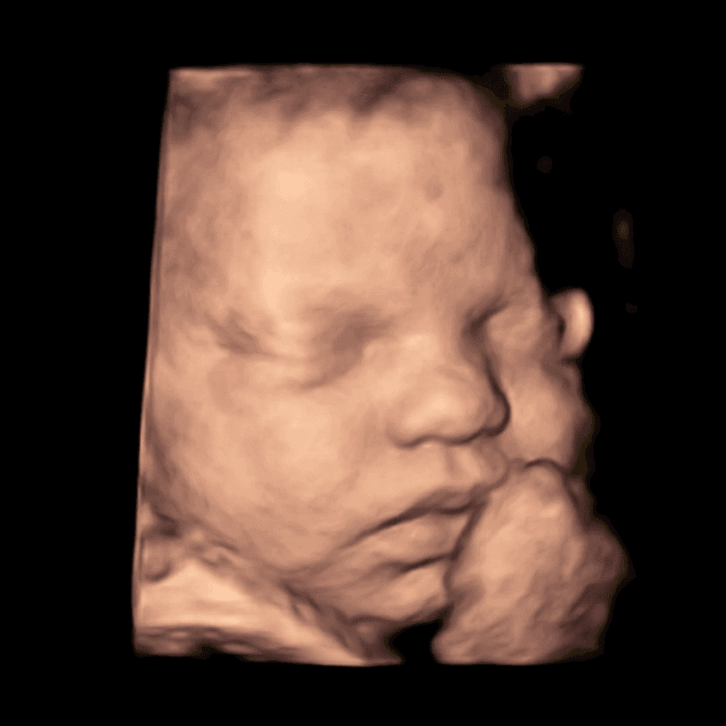 3D ultrasound scan transformed into a photorealistic newborn portrait, sample 1 — sleeping baby with hand at chin (before)