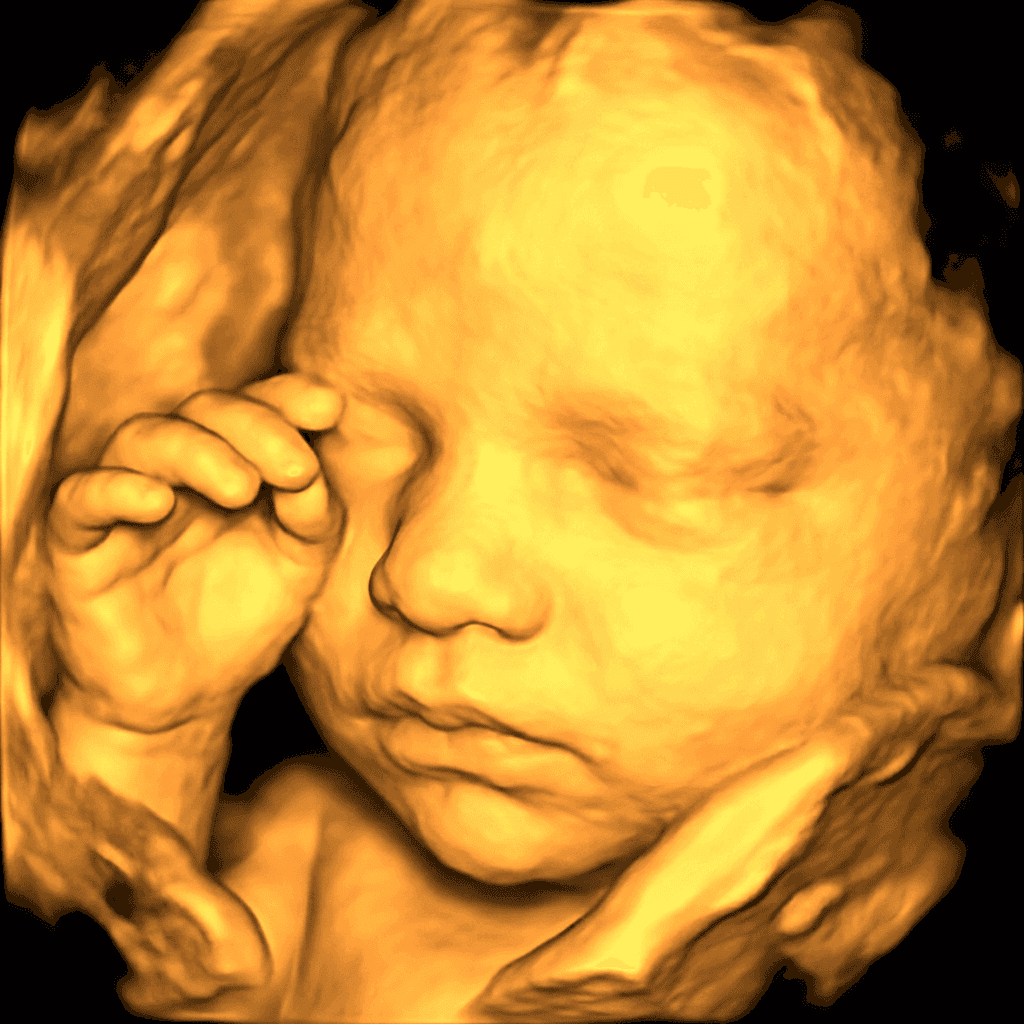 3D ultrasound scan transformed into a photorealistic newborn portrait, sample 2 — newborn with both hands near face (before)
