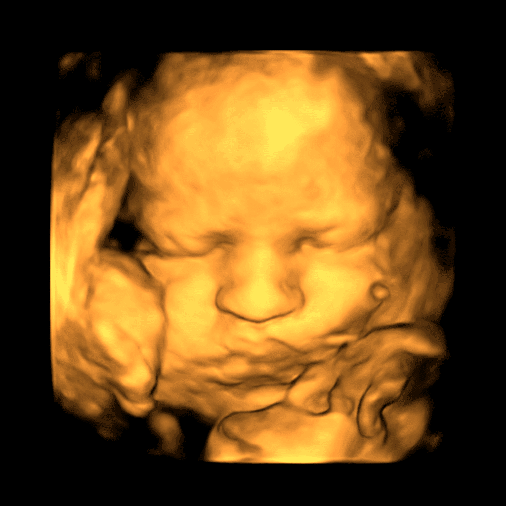 3D ultrasound scan transformed into a photorealistic newborn portrait, sample 3 — newborn with hands raised (before)