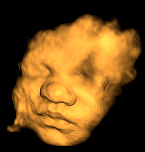 3D ultrasound scan transformed into a photorealistic newborn portrait, sample 4 — close-up of full face (before)
