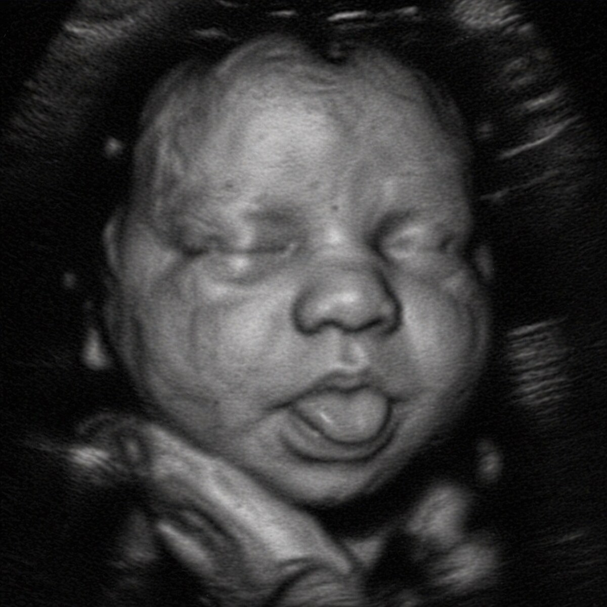 Original 3D ultrasound — Tongue-out · 3D scan