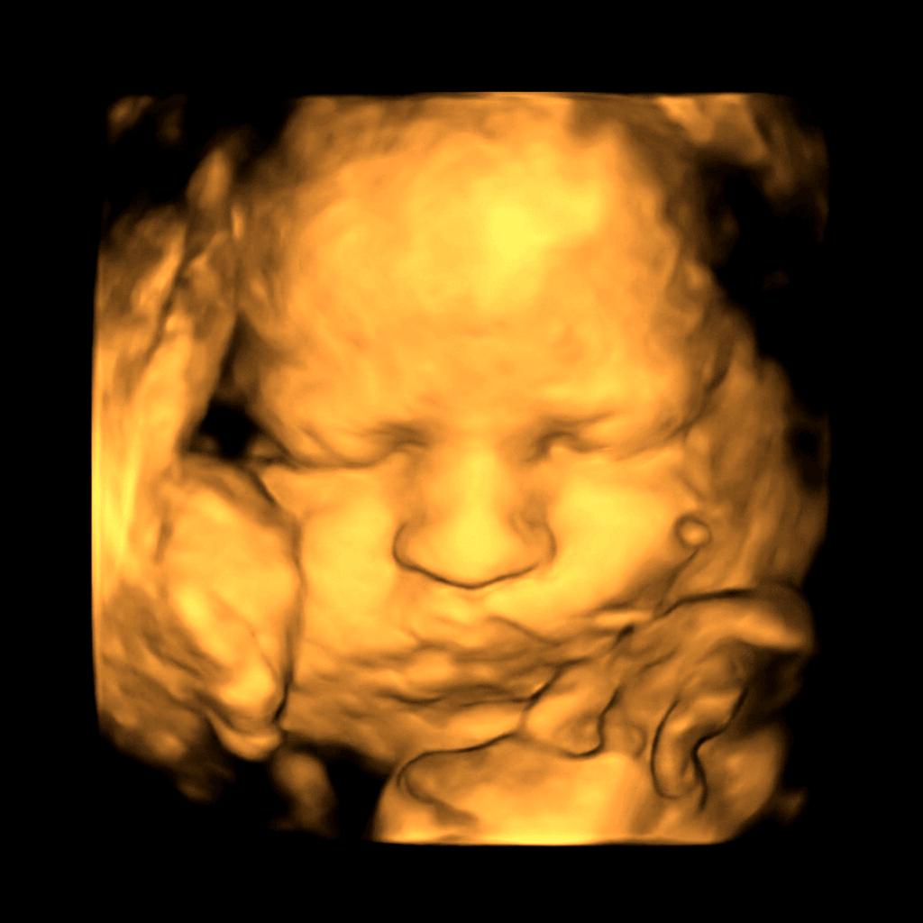 Source 3D ultrasound scan